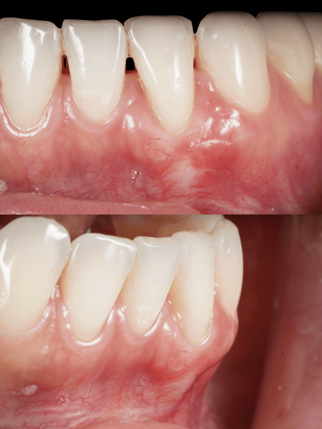 Frontal and side views of the lower front teeth at the three-month review after periodontal treatment