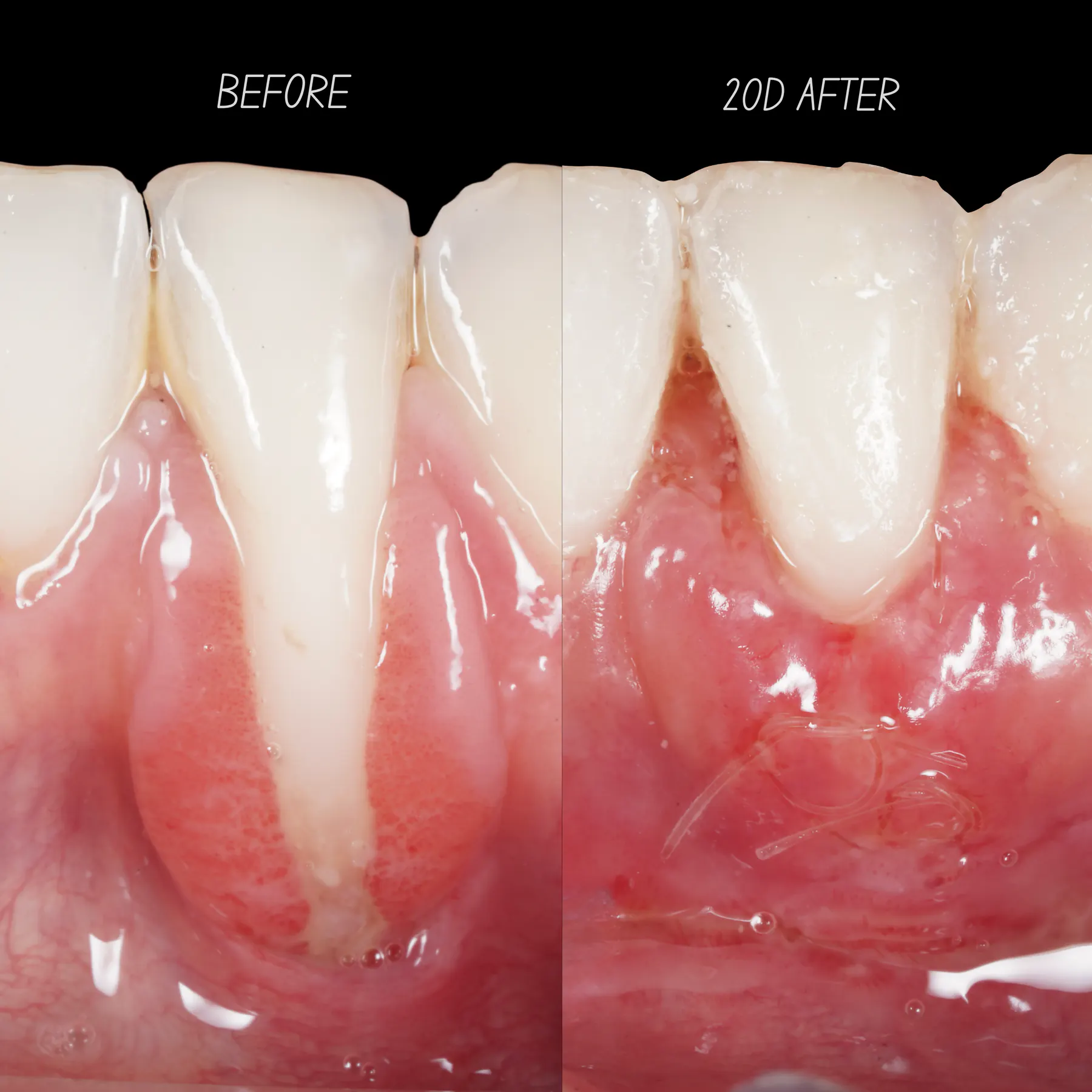 Root coverage and tissue thickening