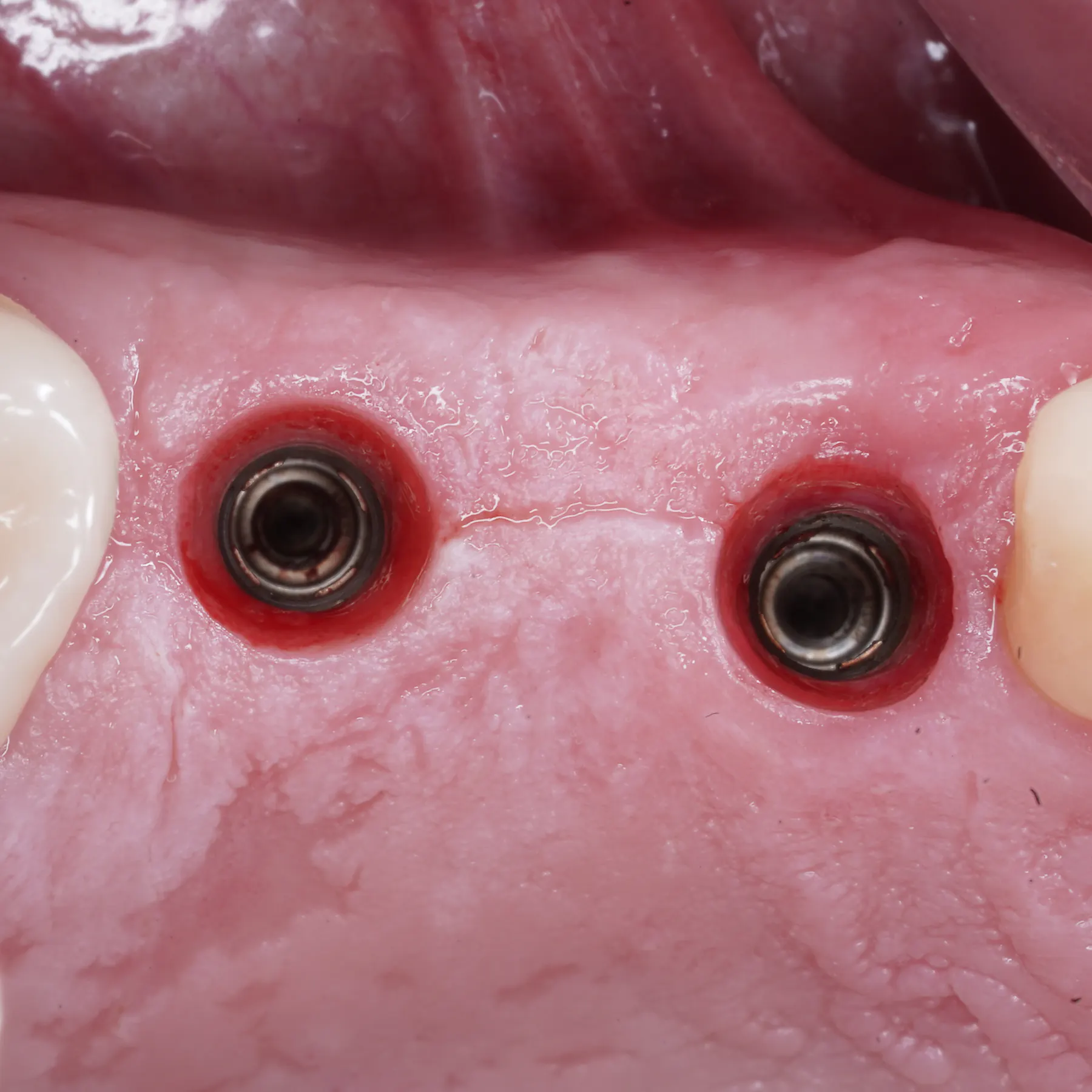 Peri-implant soft tissue reconstruction
