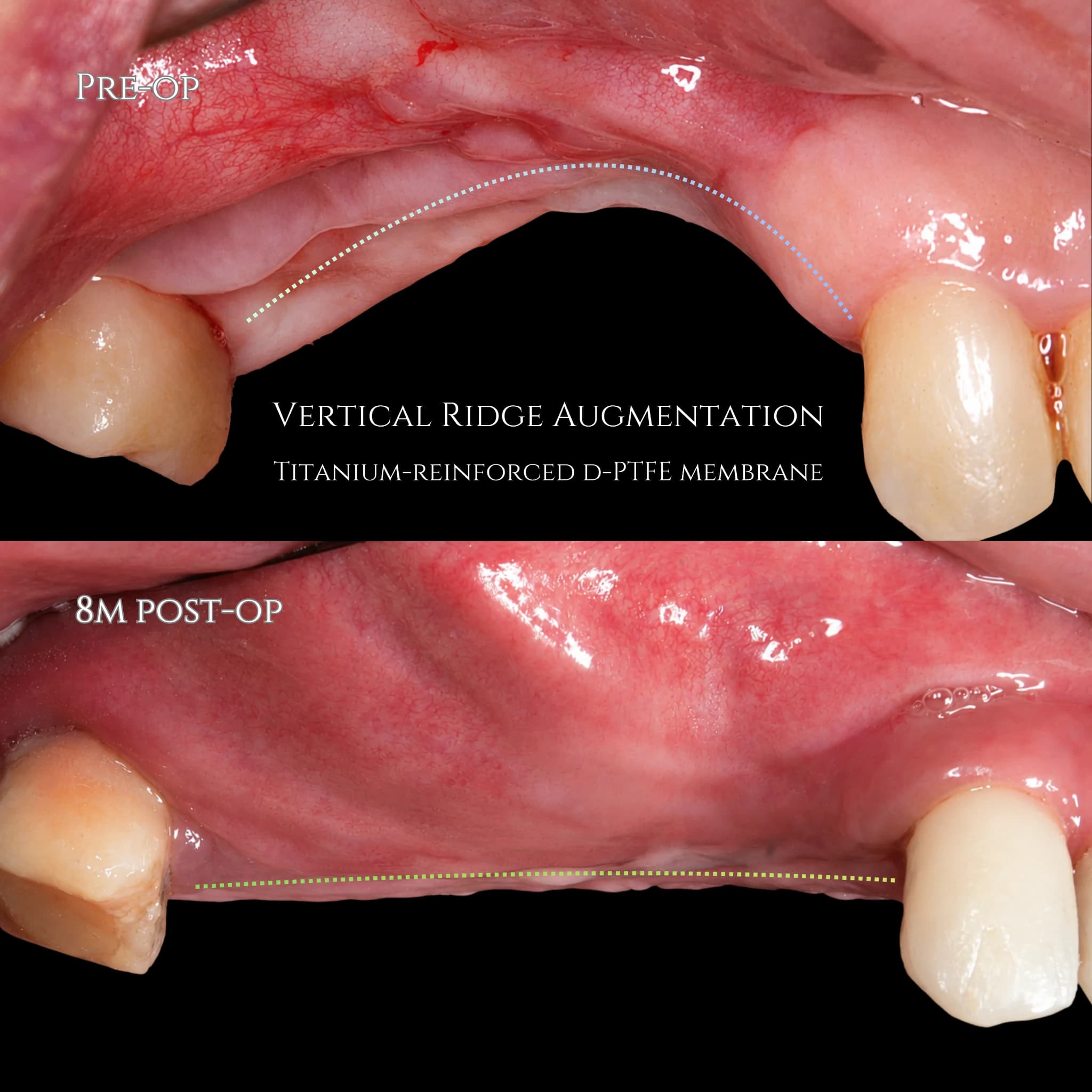 Vertical bone regeneration